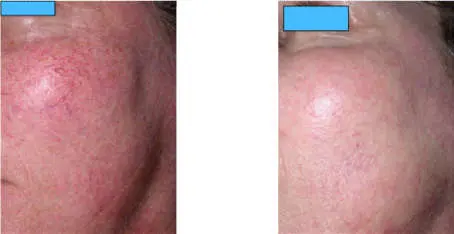 Résultat laser vasculaire